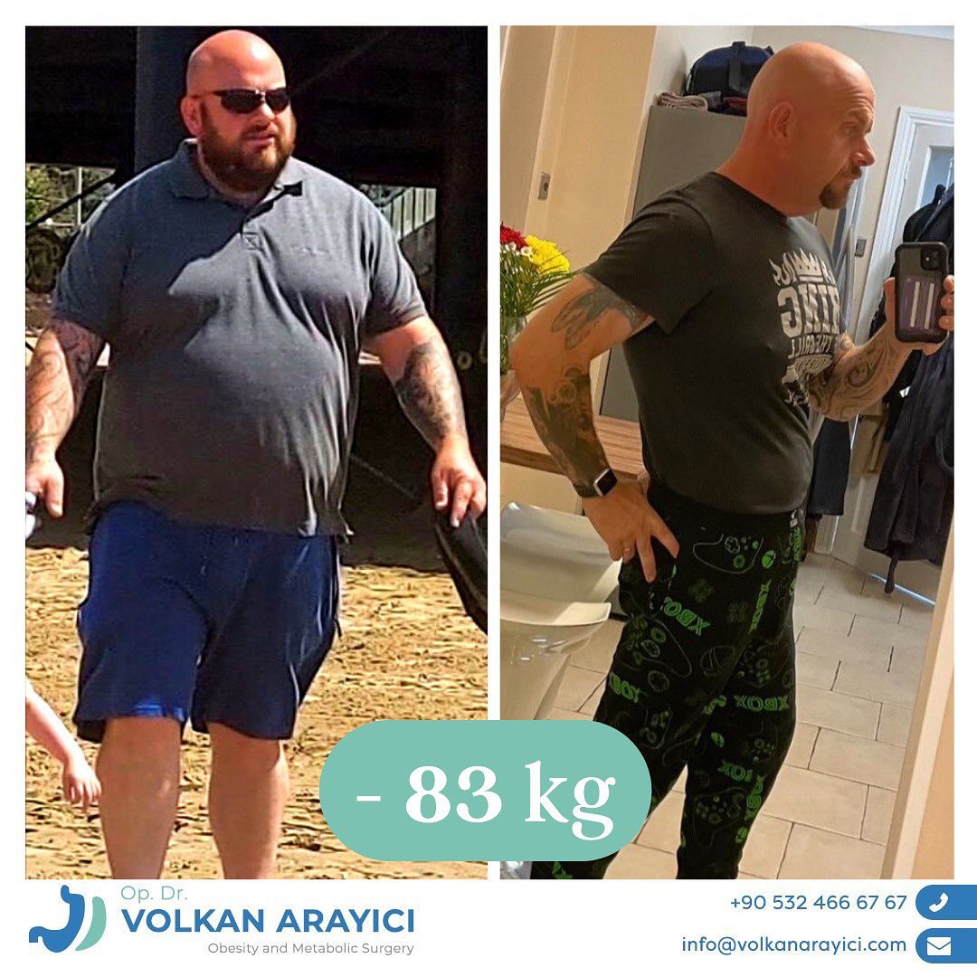 Qualität & Preis: wie teuer ist eine magenverkleinerung bei renommierten Kliniken?